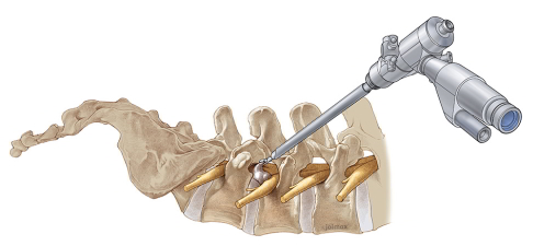 La Chirurgie Endoscopique du Rachis.